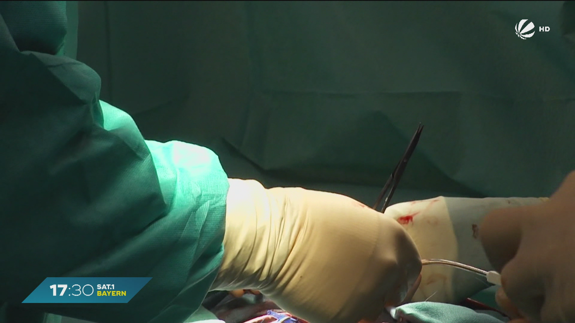 Video: Mehr Behandlungsfehler? Medizinischer Dienst prüft Verdachtsfälle