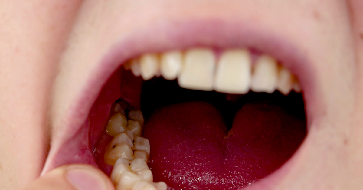 Video: Karies-Bakterium als Ursache für Parkinson?